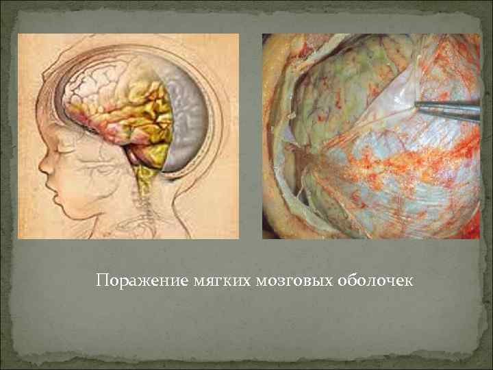 Поражение мягких мозговых оболочек 