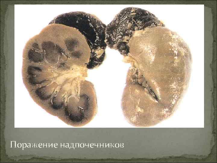 Поражение надпочечников 