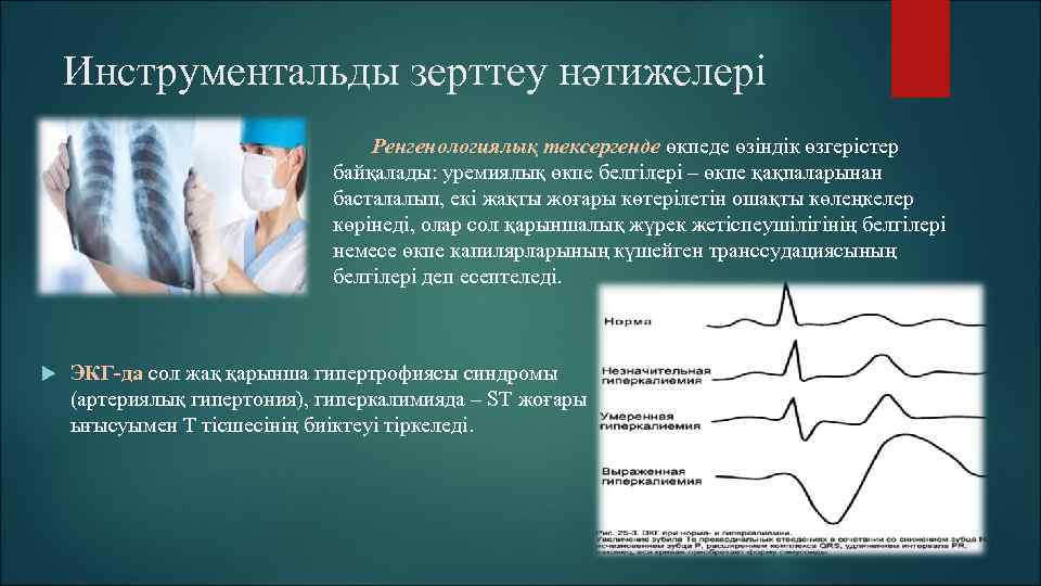 Инструментальды зерттеу нәтижелері Ренгенологиялық тексергенде өкпеде өзіндік өзгерістер байқалады: уремиялық өкпе белгілері – өкпе
