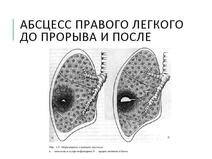 АБСЦЕСС ПРАВОГО ЛЕГКОГО ДО ПРОРЫВА И ПОСЛЕ 