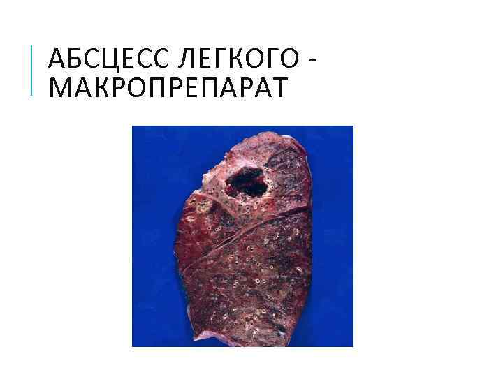 АБСЦЕСС ЛЕГКОГО  МАКРОПРЕПАРАТ 