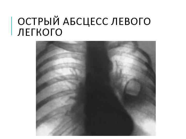ОСТРЫЙ АБСЦЕСС ЛЕВОГО ЛЕГКОГО 