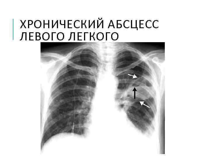 ХРОНИЧЕСКИЙ АБСЦЕСС ЛЕВОГО ЛЕГКОГО 