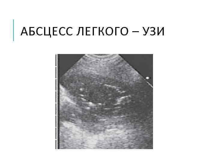АБСЦЕСС ЛЕГКОГО – УЗИ 
