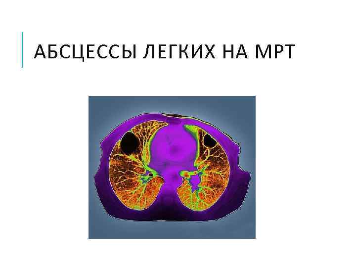 АБСЦЕССЫ ЛЕГКИХ НА МРТ 