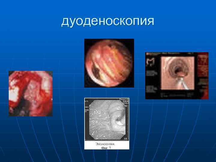 дуоденоскопия 