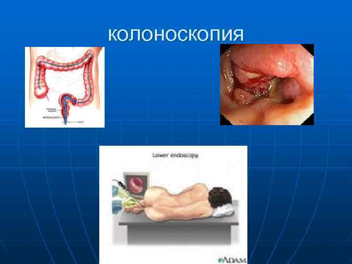 колоноскопия 