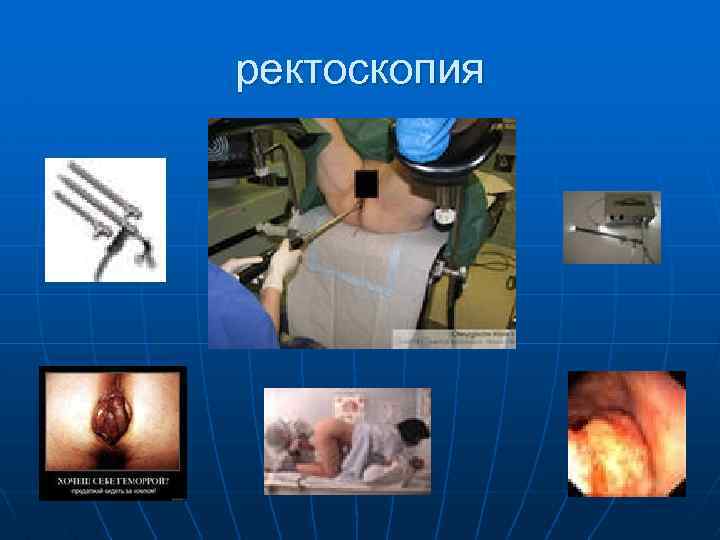 ректоскопия 