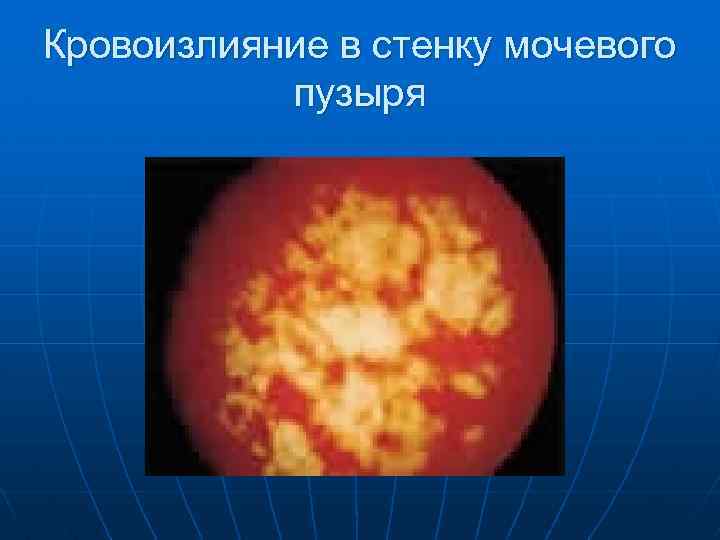 Кровоизлияние в стенку мочевого пузыря 