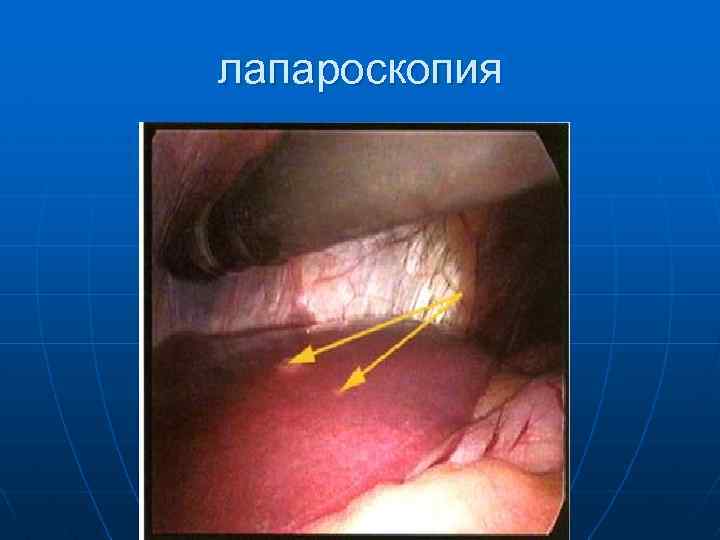 лапароскопия 