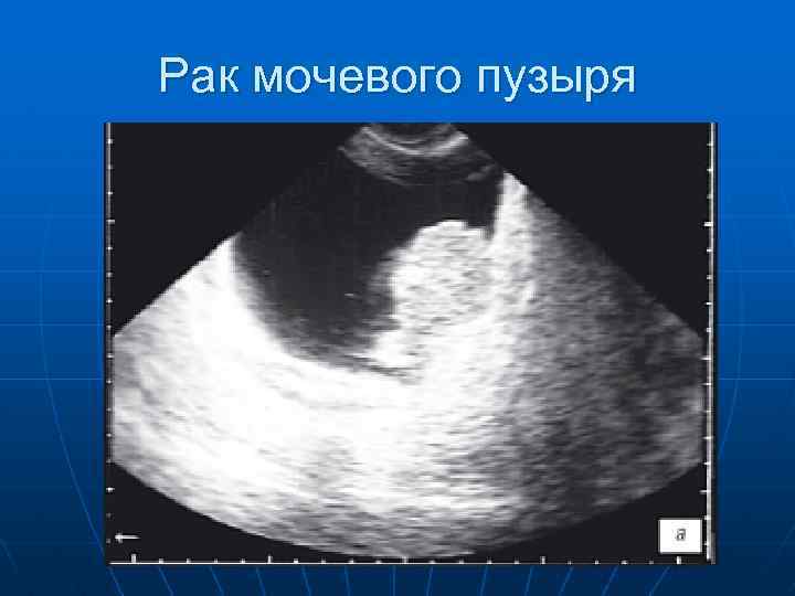 Рак мочевого пузыря 