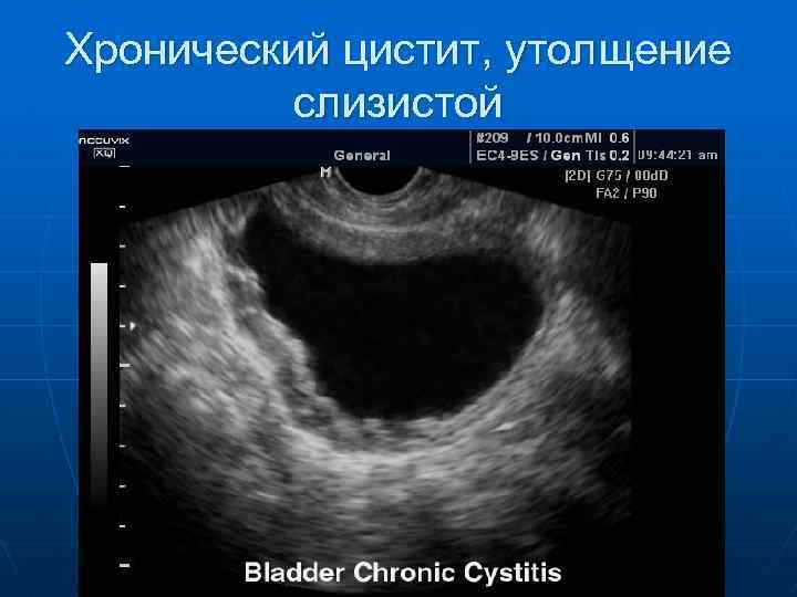 Хронический цистит, утолщение слизистой 