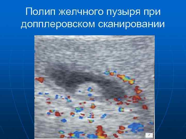Полип желчного пузыря при допплеровском сканировании 
