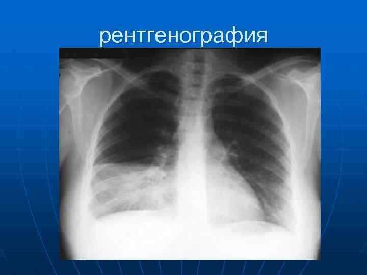 рентгенография 