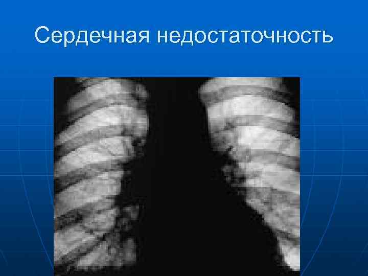 Сердечная недостаточность 