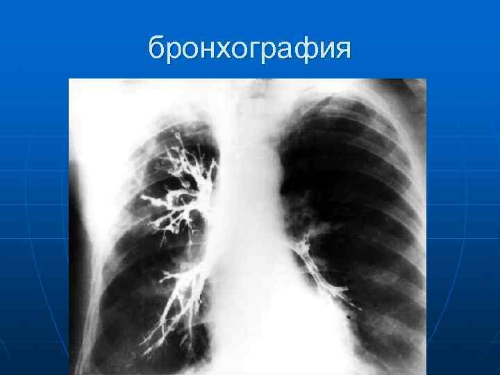 Бронхиальная пневмония. Бронхография пневмония. Контрастная рентгенография бронхов (бронхография). Хронический бронхит бронхография.