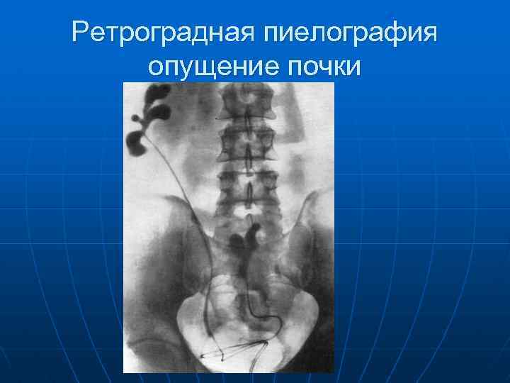 Ретроградная пиелография опущение почки 