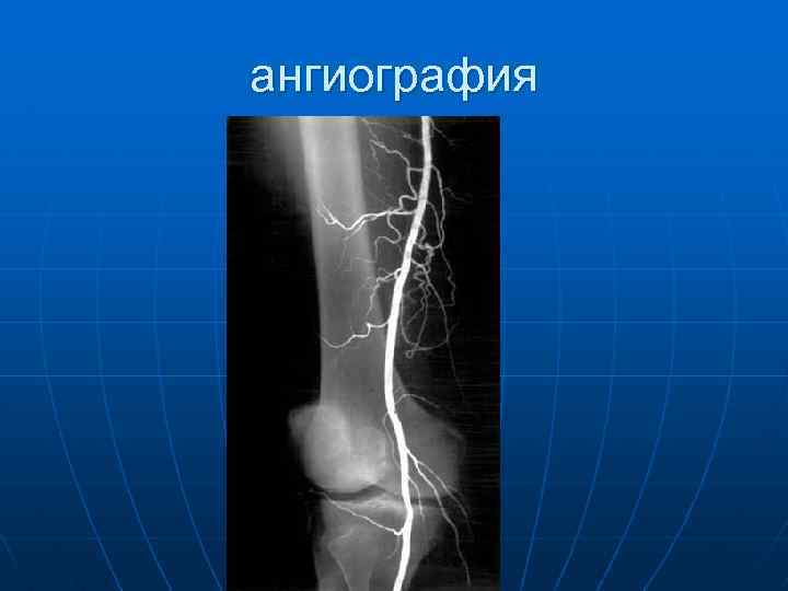 ангиография 