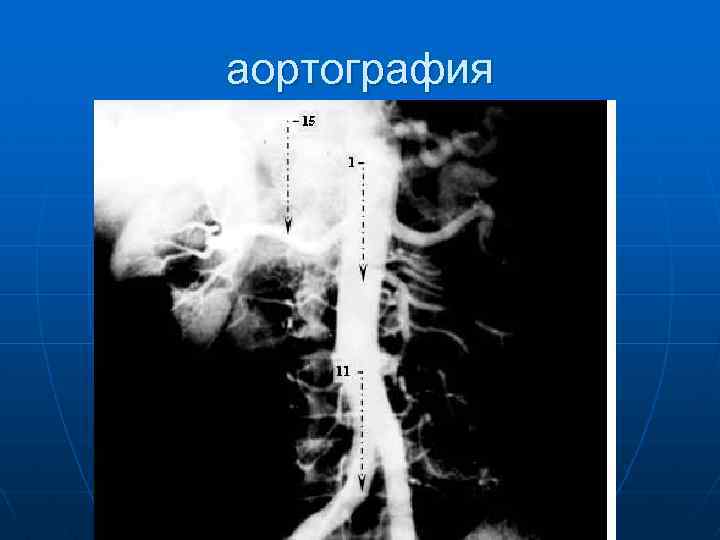 аортография 