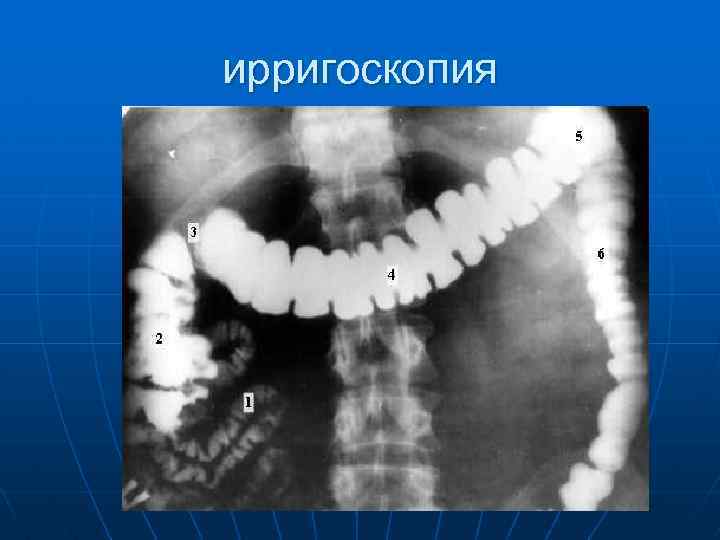 ирригоскопия 