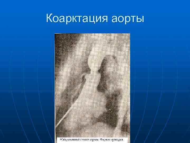 Коарктация аорты 