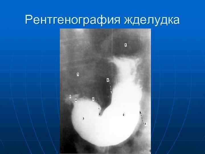 Рентгенография жделудка 