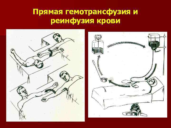 Прямая гемотрансфузия и реинфузия крови 