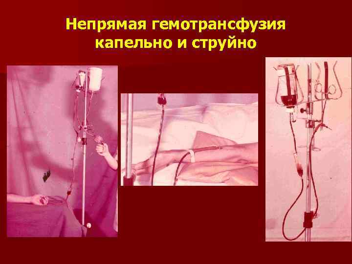Непрямая гемотрансфузия капельно и струйно 