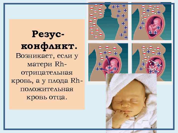Резусконфликт. Возникает, если у матери Rhотрицательная кровь, а у плода Rhположительная кровь отца. 