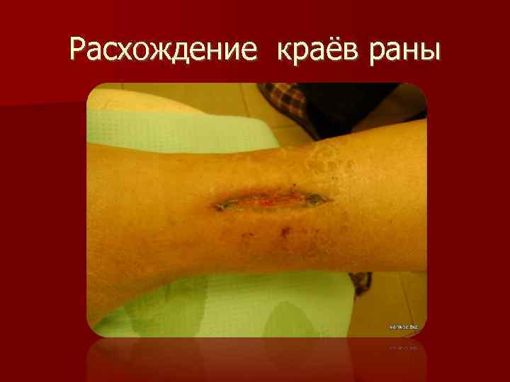 Расхождение краёв раны 