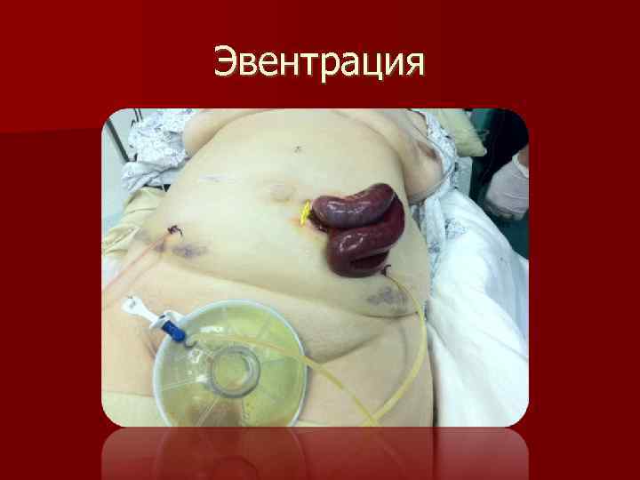 Эвентрация 