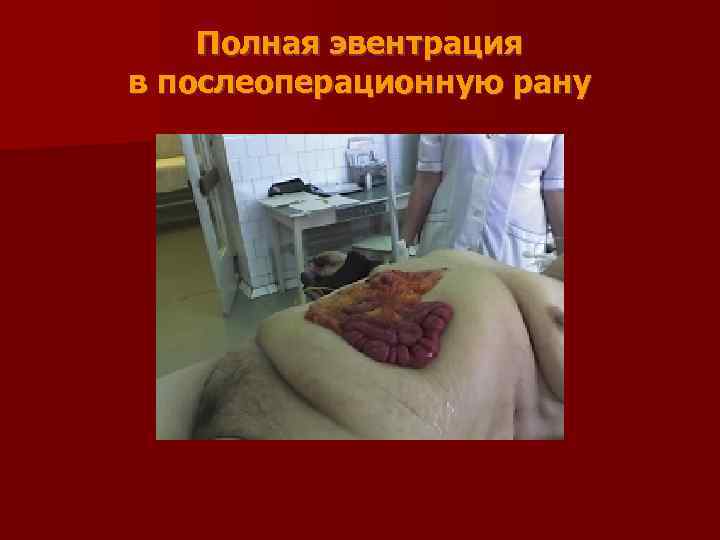   Полная эвентрация в послеоперационную рану 