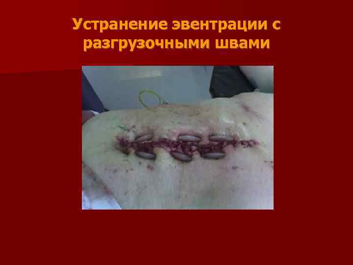 Устранение эвентрации с разгрузочными швами 