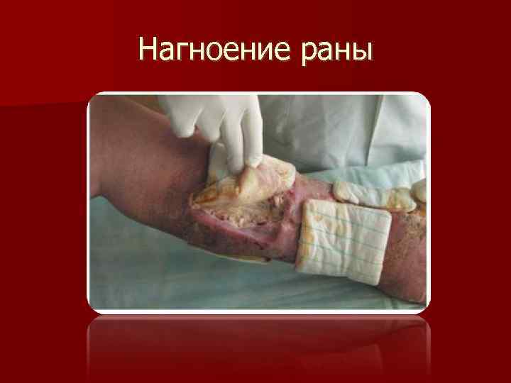 Нагноение раны 