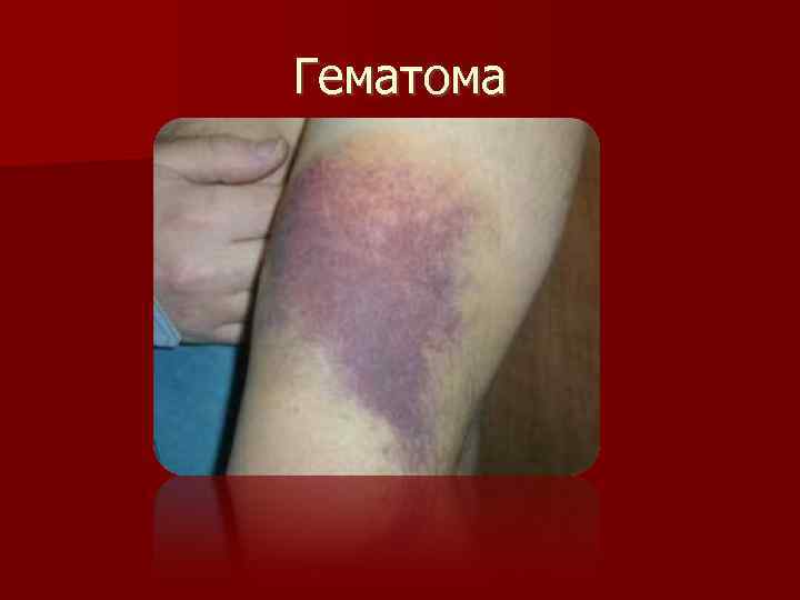 Гематома 