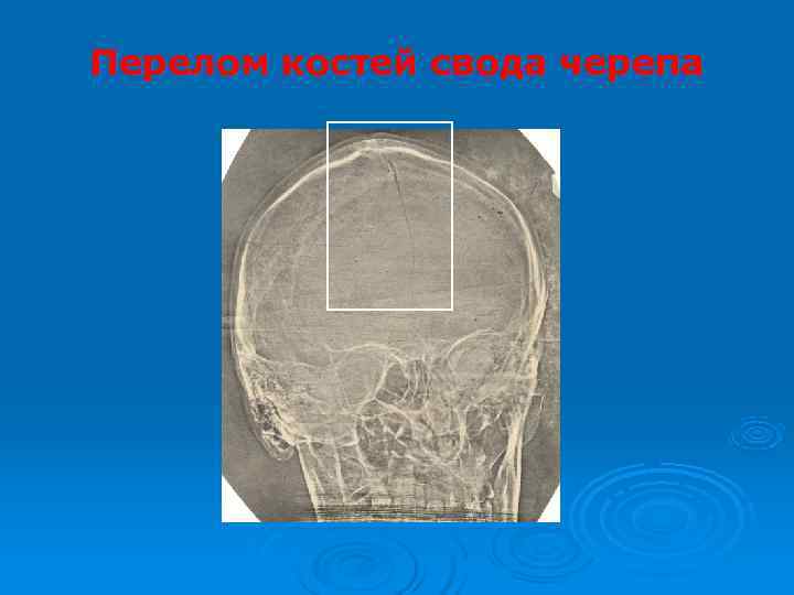 Перелом костей свода черепа 