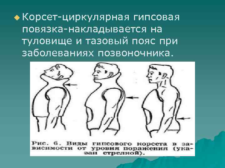 u Корсет циркулярная гипсовая  повязка накладывается на  туловище и тазовый пояс при