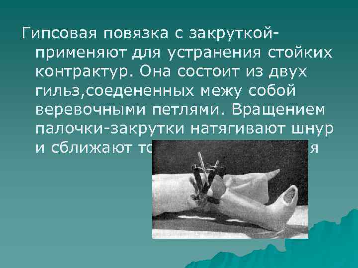 Гипсовая повязка с закруткой  применяют для устранения стойких  контрактур. Она состоит из