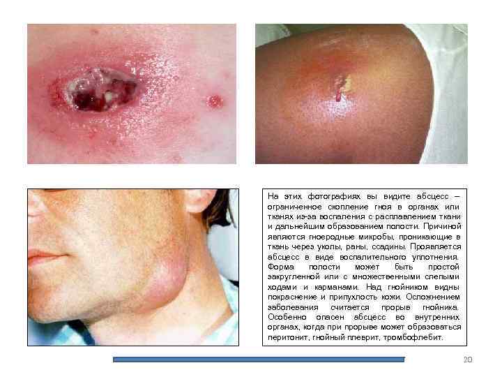 На этих фотографиях вы видите абсцесс – ограниченное скопление гноя в органах или тканях