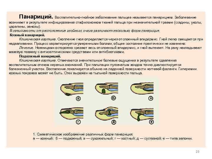  Панариций. Воспалительно-гнойное заболевание пальцев называется панарицием. Заболевание возникает в результате инфицирования стафилококком тканей