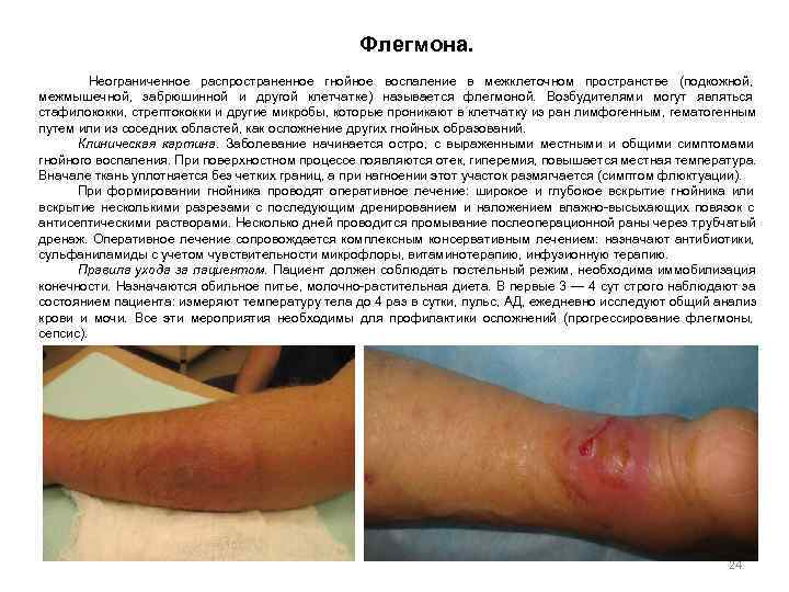      Флегмона.   Неограниченное распространенное гнойное воспаление в межклеточном