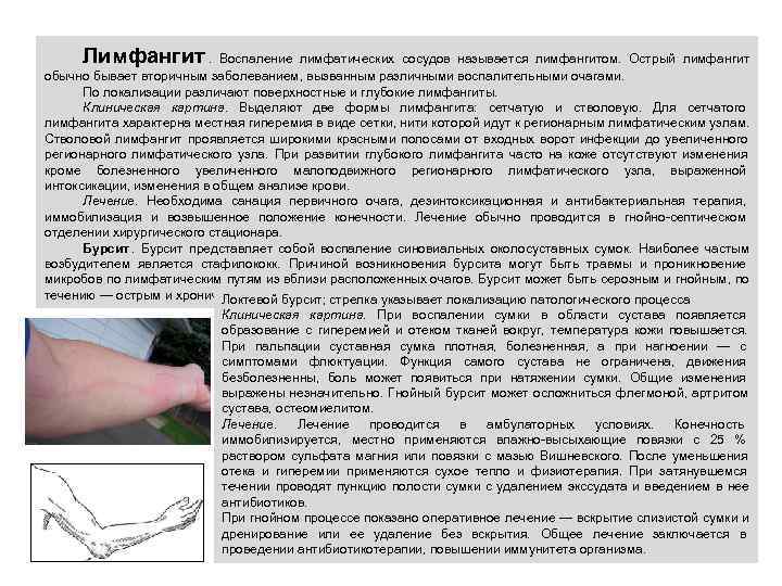  Лимфангит.  Воспаление лимфатических сосудов называется лимфангитом.  Острый лимфангит обычно бывает вторичным