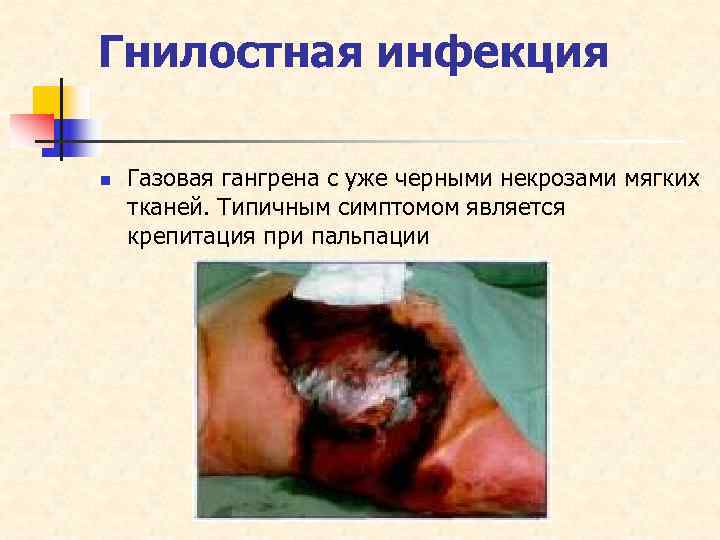 Гнилостная инфекция n  Газовая гангрена с уже черными некрозами мягких тканей. Типичным симптомом