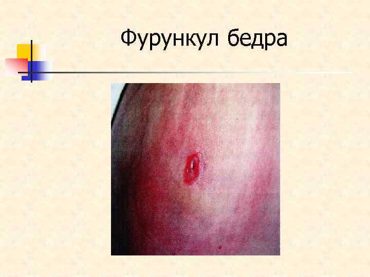 Фурункул бедра 