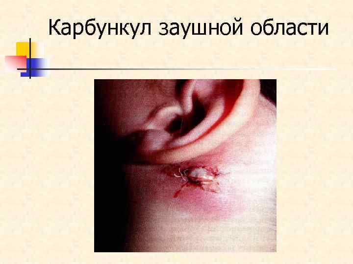 Карбункул заушной области 