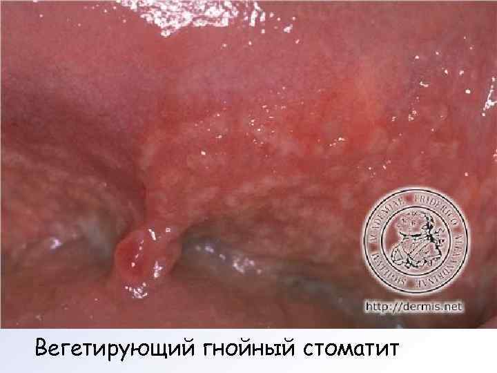 Вегетирующий гнойный стоматит 