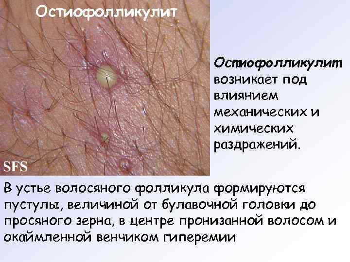   Остиофолликулит     возникает под     влиянием