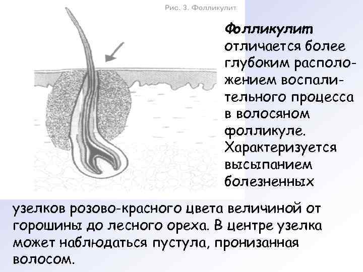       Фолликулит     отличается более 