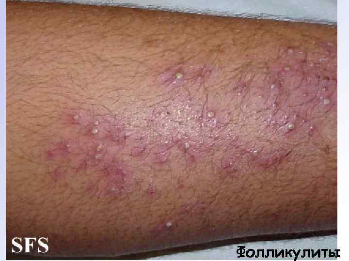 Фолликулиты 
