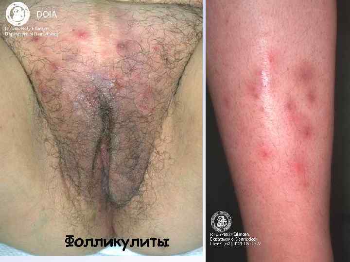 Фолликулиты 